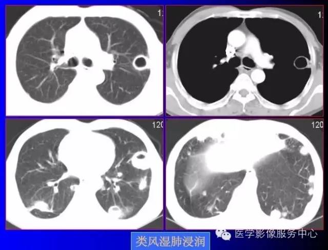 【病例】类风湿肺部浸润1例CT影像表现 【病例】类风湿肺部浸润1例CT影像表现