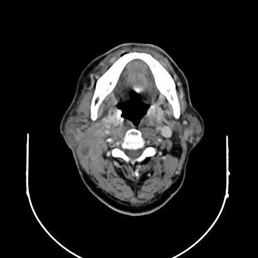 【病例】腮腺腺淋巴瘤1例影像表现 【病例】腮腺腺淋巴瘤1例影像表现
