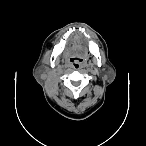 【病例】腮腺腺淋巴瘤1例影像表现 【病例】腮腺腺淋巴瘤1例影像表现
