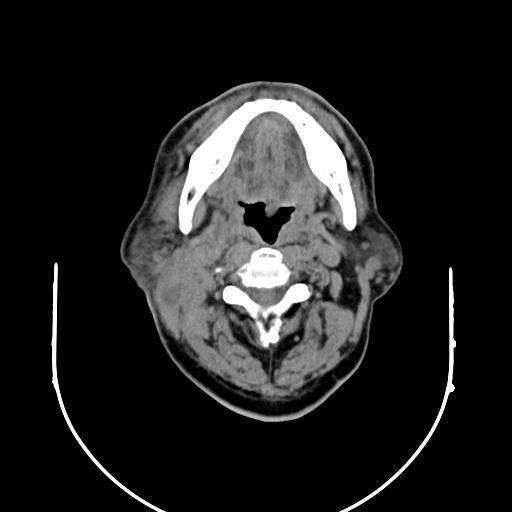 【病例】腮腺腺淋巴瘤1例影像表现 【病例】腮腺腺淋巴瘤1例影像表现