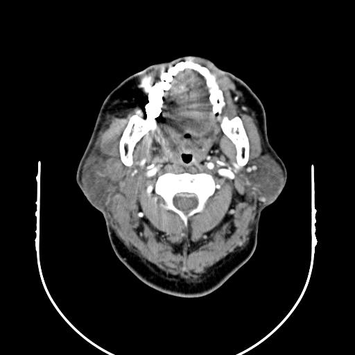 【病例】腮腺腺淋巴瘤1例影像表现 【病例】腮腺腺淋巴瘤1例影像表现