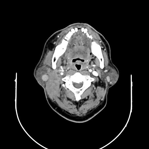 【病例】腮腺腺淋巴瘤1例影像表现 【病例】腮腺腺淋巴瘤1例影像表现