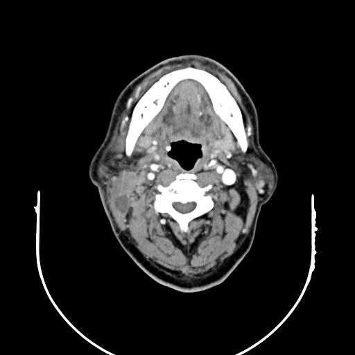 【病例】腮腺腺淋巴瘤1例影像表现 【病例】腮腺腺淋巴瘤1例影像表现