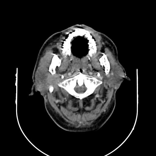 【病例】腮腺腺淋巴瘤1例影像表现 【病例】腮腺腺淋巴瘤1例影像表现