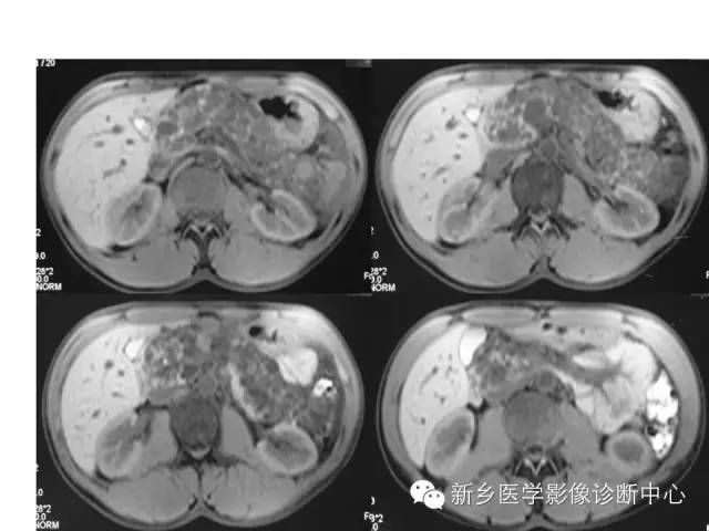 【病例】VHL综合征胰腺病变1例MR影像表现