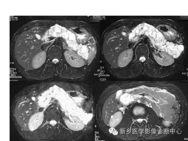 【病例】VHL综合征胰腺病变1例MR影像表现