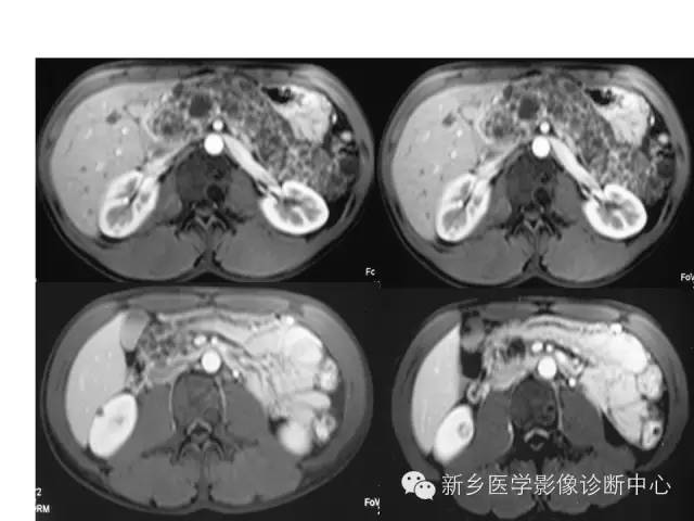【病例】VHL综合征胰腺病变1例MR影像表现