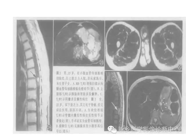 【病例】VHL综合征胰腺病变1例MR影像表现