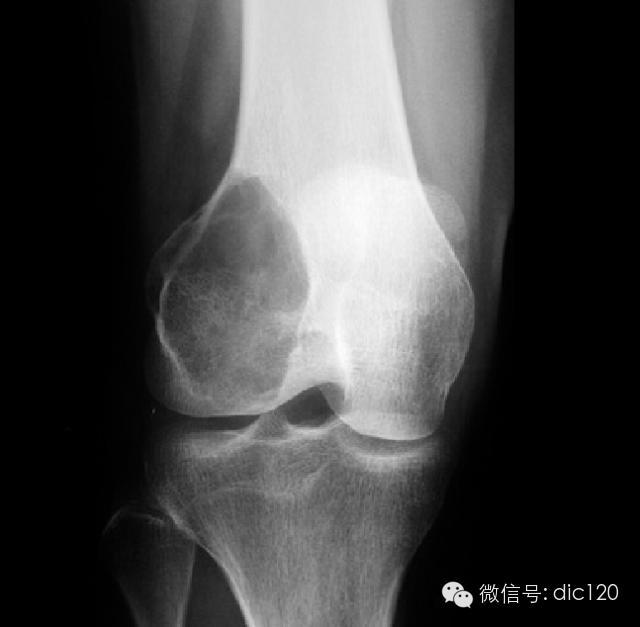 长骨偏心性膨胀性病变