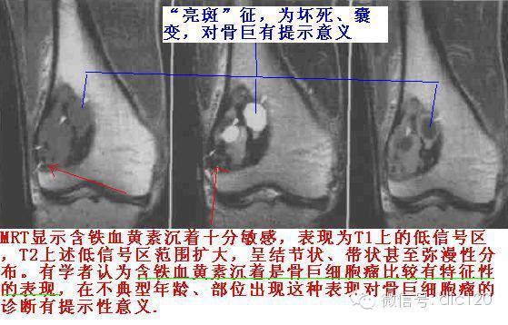 长骨偏心性膨胀性病变 长骨偏心性膨胀性病变