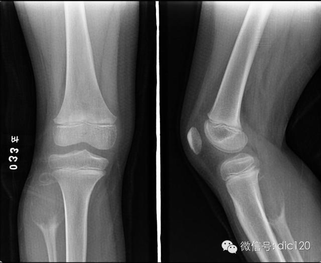 长骨偏心性膨胀性病变 长骨偏心性膨胀性病变