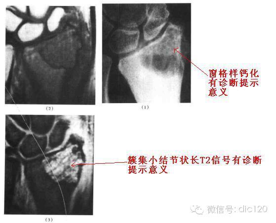 长骨偏心性膨胀性病变 长骨偏心性膨胀性病变