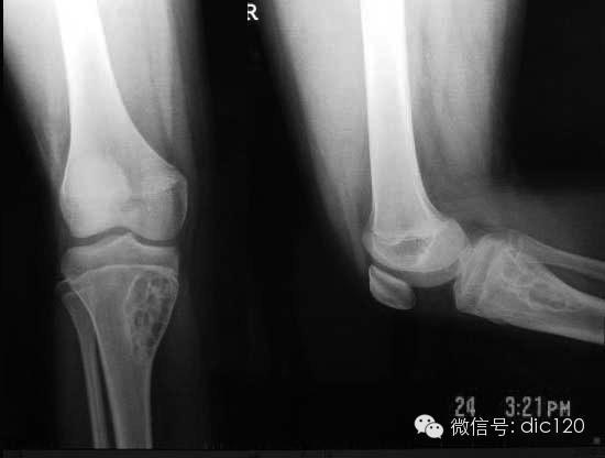 长骨偏心性膨胀性病变 长骨偏心性膨胀性病变