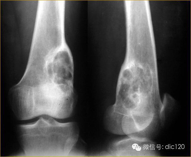 长骨偏心性膨胀性病变 长骨偏心性膨胀性病变