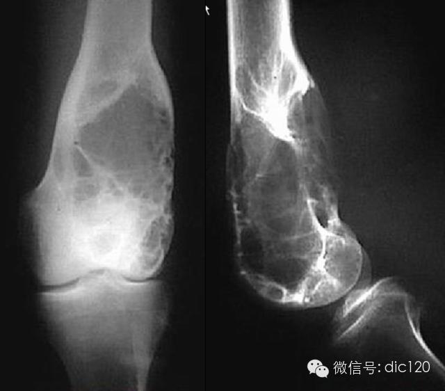 长骨偏心性膨胀性病变 长骨偏心性膨胀性病变