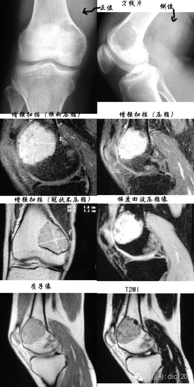 长骨偏心性膨胀性病变 长骨偏心性膨胀性病变
