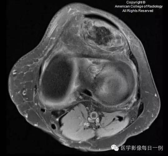 【病例】局灶性色素沉着绒毛结节性滑膜炎1例MR影像表现 【病例】局灶性色素沉着绒毛结节性滑膜炎1例MR影像表现