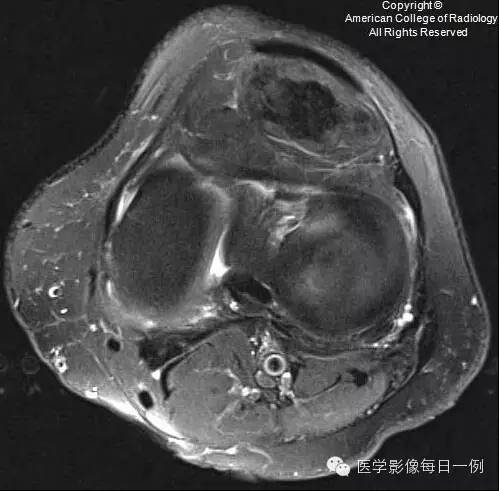 【病例】局灶性色素沉着绒毛结节性滑膜炎1例MR影像表现 【病例】局灶性色素沉着绒毛结节性滑膜炎1例MR影像表现