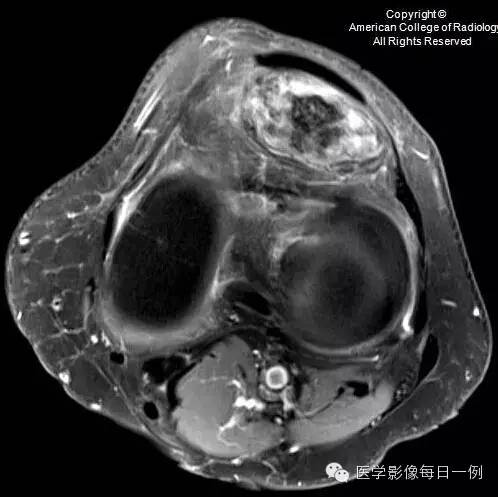 【病例】局灶性色素沉着绒毛结节性滑膜炎1例MR影像表现 【病例】局灶性色素沉着绒毛结节性滑膜炎1例MR影像表现