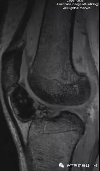 【病例】局灶性色素沉着绒毛结节性滑膜炎1例MR影像表现 【病例】局灶性色素沉着绒毛结节性滑膜炎1例MR影像表现
