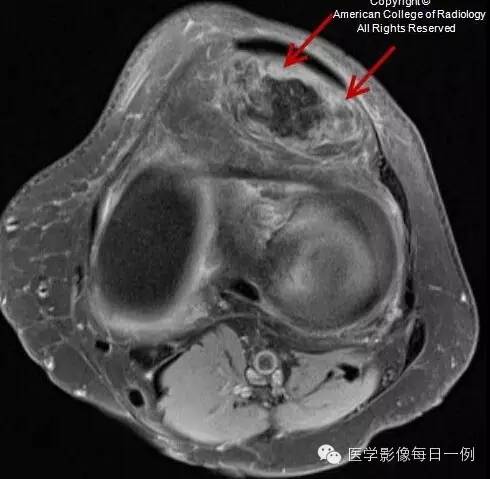 【病例】局灶性色素沉着绒毛结节性滑膜炎1例MR影像表现 【病例】局灶性色素沉着绒毛结节性滑膜炎1例MR影像表现