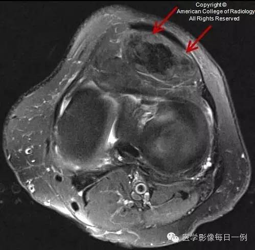【病例】局灶性色素沉着绒毛结节性滑膜炎1例MR影像表现 【病例】局灶性色素沉着绒毛结节性滑膜炎1例MR影像表现