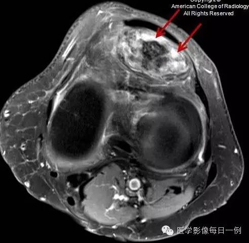 【病例】局灶性色素沉着绒毛结节性滑膜炎1例MR影像表现 【病例】局灶性色素沉着绒毛结节性滑膜炎1例MR影像表现