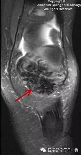 【病例】局灶性色素沉着绒毛结节性滑膜炎1例MR影像表现 【病例】局灶性色素沉着绒毛结节性滑膜炎1例MR影像表现