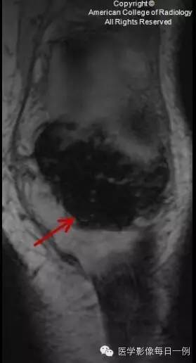 【病例】局灶性色素沉着绒毛结节性滑膜炎1例MR影像表现 【病例】局灶性色素沉着绒毛结节性滑膜炎1例MR影像表现