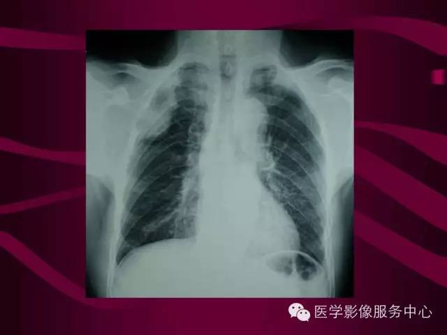 【病例】肋骨血管瘤1例影像表现