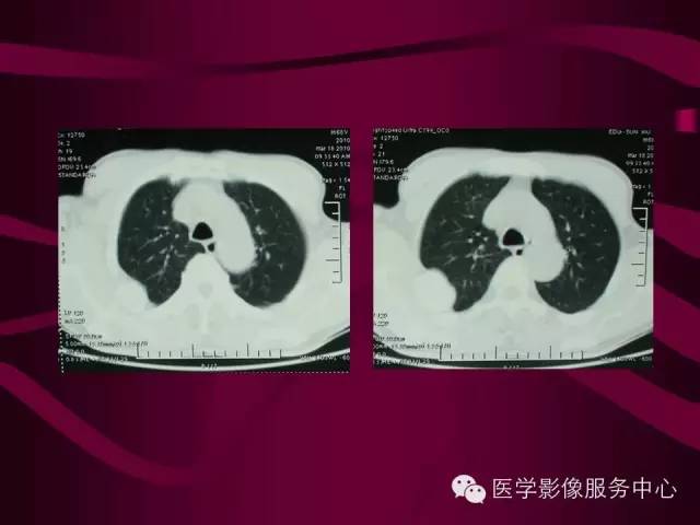 【病例】肋骨血管瘤1例影像表现 【病例】肋骨血管瘤1例影像表现
