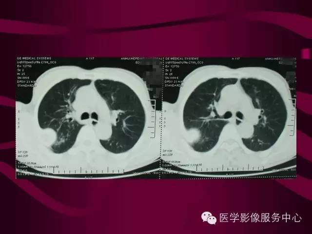 【病例】肋骨血管瘤1例影像表现 【病例】肋骨血管瘤1例影像表现