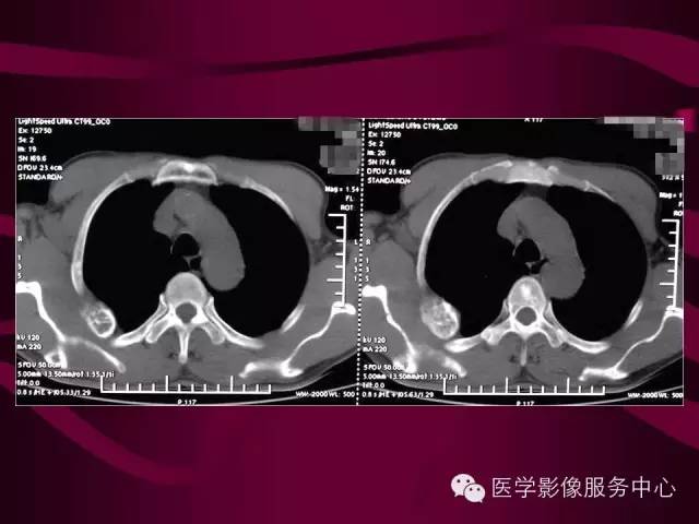 【病例】肋骨血管瘤1例影像表现 【病例】肋骨血管瘤1例影像表现