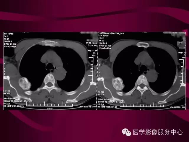 【病例】肋骨血管瘤1例影像表现 【病例】肋骨血管瘤1例影像表现