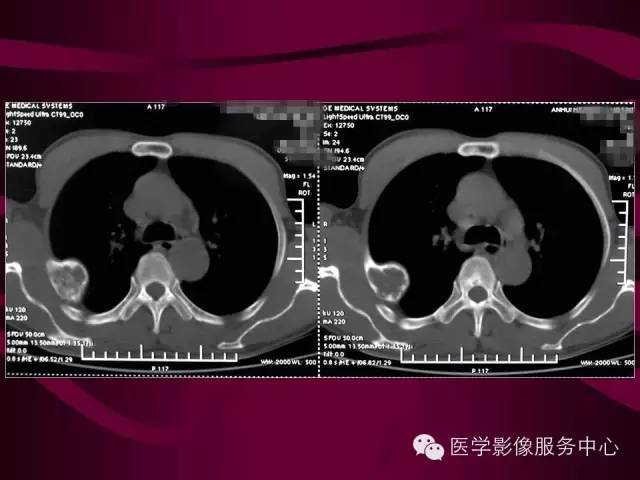 【病例】肋骨血管瘤1例影像表现 【病例】肋骨血管瘤1例影像表现