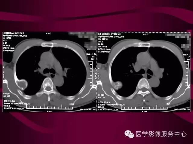 【病例】肋骨血管瘤1例影像表现 【病例】肋骨血管瘤1例影像表现