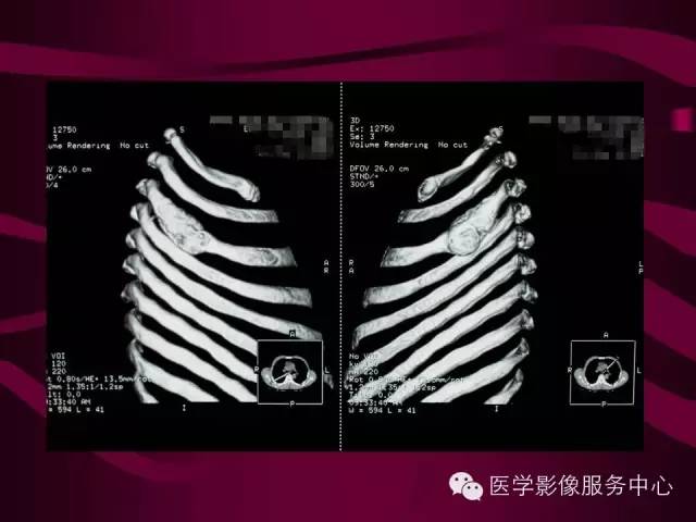【病例】肋骨血管瘤1例影像表现 【病例】肋骨血管瘤1例影像表现