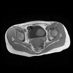【病例】膀胱平滑肌瘤1例MR影像表现 【病例】膀胱平滑肌瘤1例MR影像表现