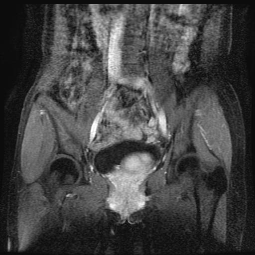 【病例】膀胱平滑肌瘤1例MR影像表现 【病例】膀胱平滑肌瘤1例MR影像表现