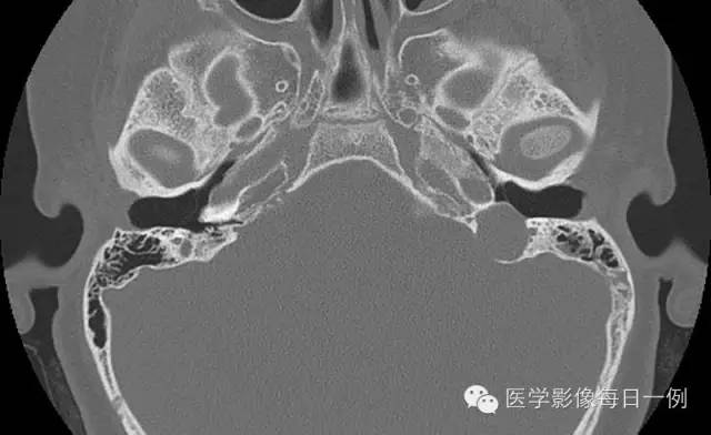 【病例】左侧颈静脉球裸露1例影像表现