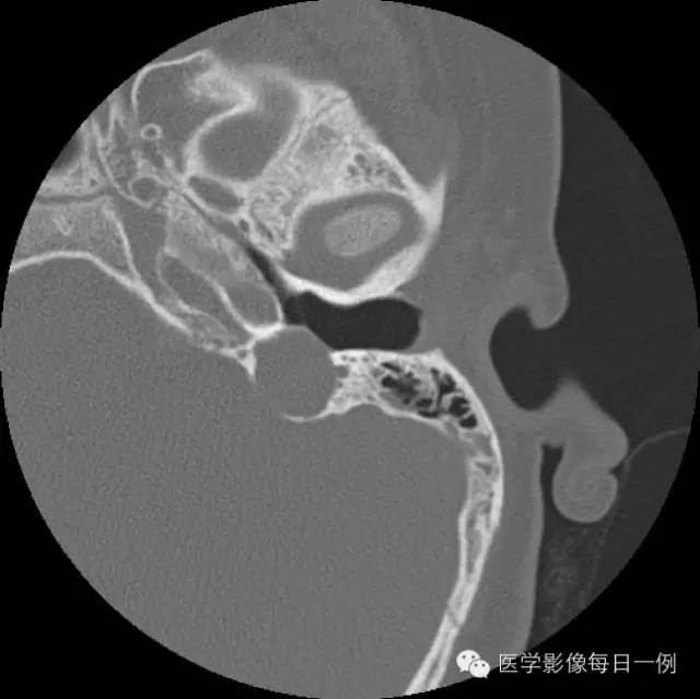 【病例】左侧颈静脉球裸露1例影像表现