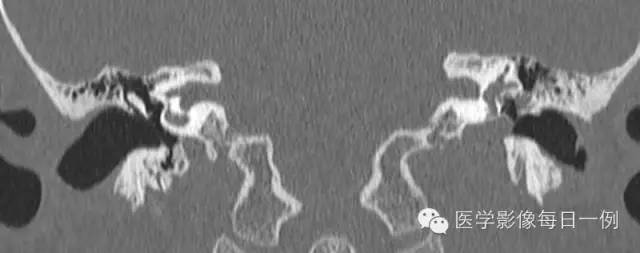 【病例】左侧颈静脉球裸露1例影像表现