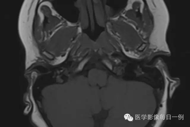 【病例】左侧颈静脉球裸露1例影像表现