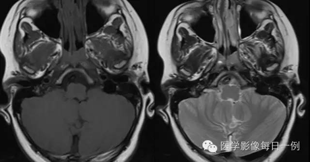 【病例】左侧颈静脉球裸露1例影像表现