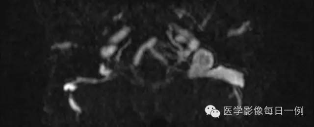 【病例】左侧颈静脉球裸露1例影像表现