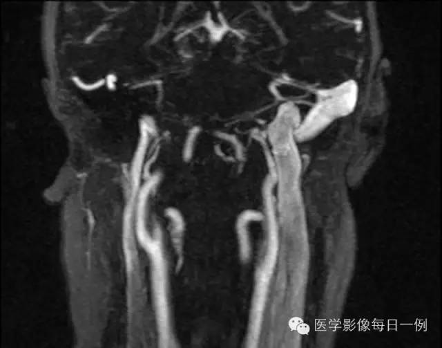 【病例】左侧颈静脉球裸露1例影像表现