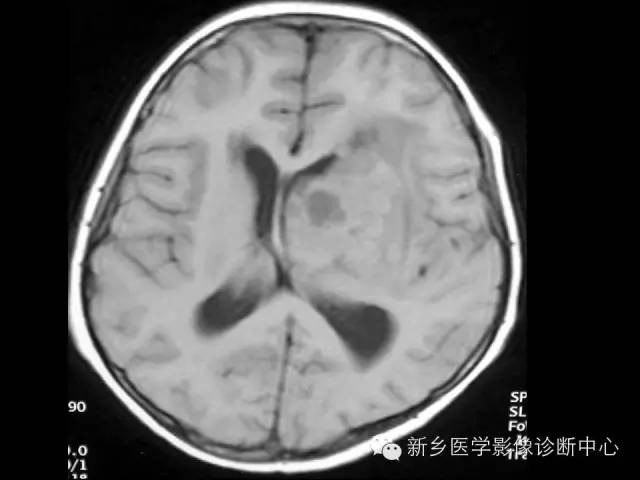 【病例】丘脑生殖细胞瘤1例MR影像表现