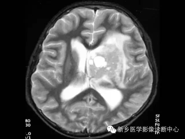 【病例】丘脑生殖细胞瘤1例MR影像表现