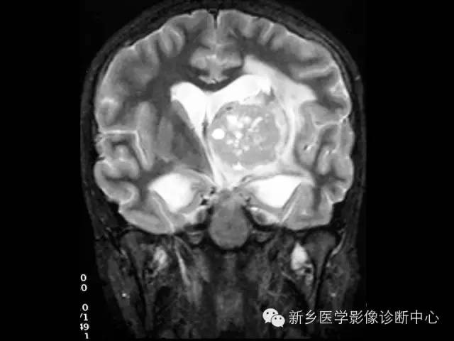 【病例】丘脑生殖细胞瘤1例MR影像表现