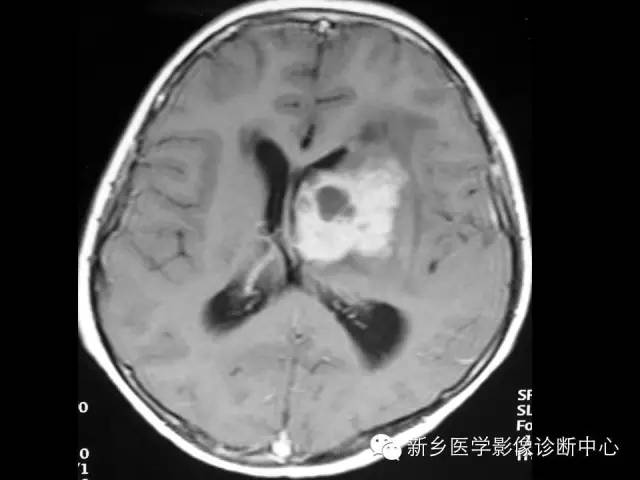 【病例】丘脑生殖细胞瘤1例MR影像表现